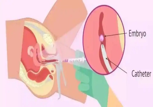 偶發(fā)還是遺傳？看看4號(hào)染色體三體異?，F(xiàn)象的真正原因